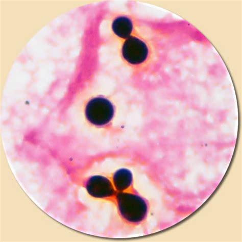 Cryptococcus gattii - CSF Gram Stain