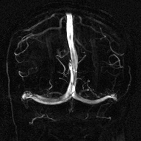 Phase Contrast MRA - Questions and Answers in MRI