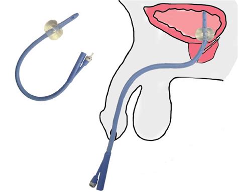 Foley Catheter (Dover 26 Fr) | Download Scientific Diagram