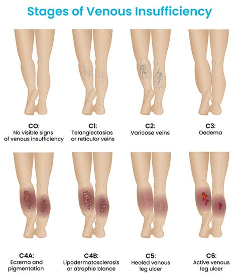 What are the 8 stages of the CEAP classification of venous ...