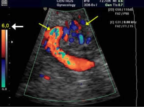 COLOUR DOPPLER?? At pulsehospitalpune.com Ultrasonic colour Doppler is ...