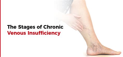 The Stages of Chronic Venous Insufficiency