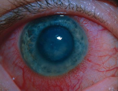 Stromal Herpetic Keratitis in the eye – from a cold sore? | Eyes and ...