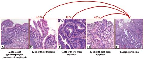 Figure 1 from Barrett's esophagus and esophageal cancer: an overview ...