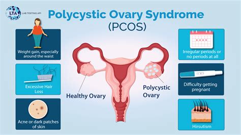 Polycystic Ovary Syndrome (PCOS): Causes, Signs, and Symptoms | Lab ...