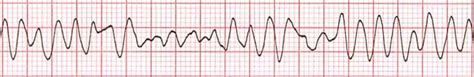 Ventricular Fibrillation training - ACLS Cardiac Rhythms video | ProACLS