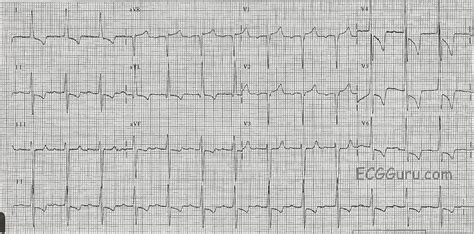 Left Ventricular Hypertrophy With Strain | ECG Guru - Instructor Resources