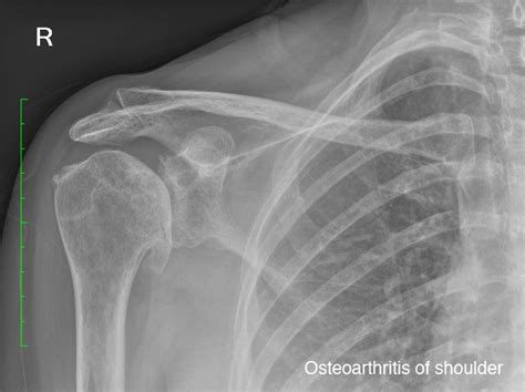 Surgical Treatment of Arthritis of the Shoulder | Neill Thompson