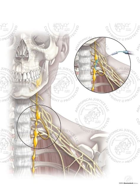 Female Left Stellate Ganglion Block - No Text