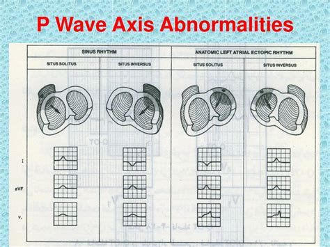 PPT - Pediatric EKG PowerPoint Presentation, free download - ID:3404010