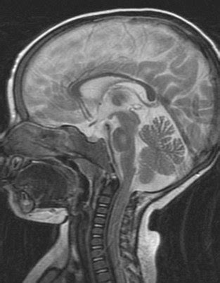 Central Pontine Myelinolysis - Sumer's Radiology Blog