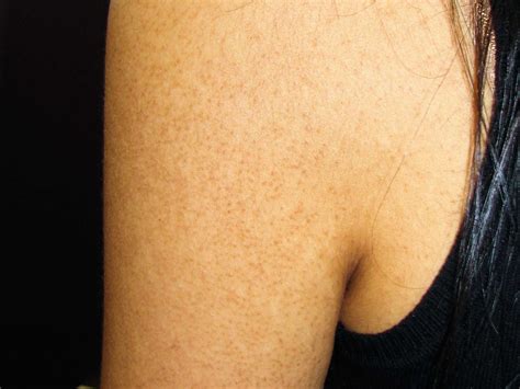 Keratosis Pilaris: Types, Symptoms, Causes, Treatment