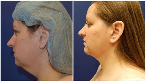 Double Chin Liposuction Surgery Milwaukee - Milwaukeeliposuction.com