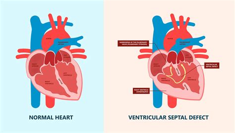 Ventricular Septal defect - Symptoms, Causes & Risk Factors | Dr Raghu