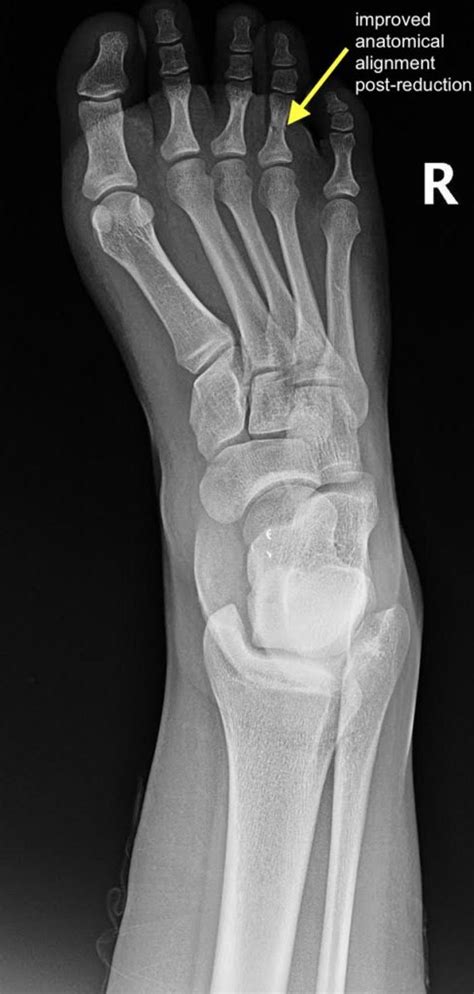 Proximal Phalanx Fracture of the Foot. XRay Postreduction, Annotated ...