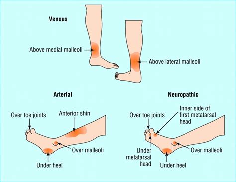 Types and typical sites of leg ulcer Nursing School Studying, Nursing ...