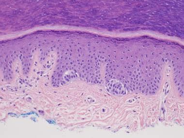 Pathology of Benign Melanocytic Nevi: Overview, Pathophysiology and ...