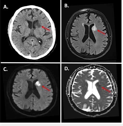 CT and MRI following left caudate nucleus stroke A. CT head showing ...