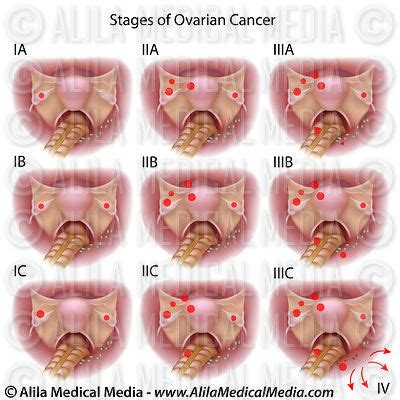 Alila Medical Media | Ovarian Cancer stages I | Medical illustration