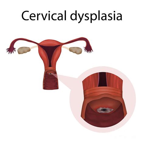 Cervical Dysplasia Photograph by Veronika Zakharova/science Photo Library