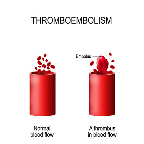 Purpura, Thrombotic Thrombocytopenic : Overview, Causes, Symptoms ...