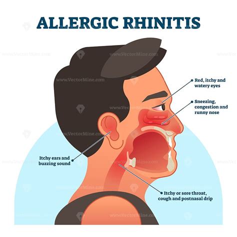 Allergic rhinitis medical diagram, vector illustration labeled ...