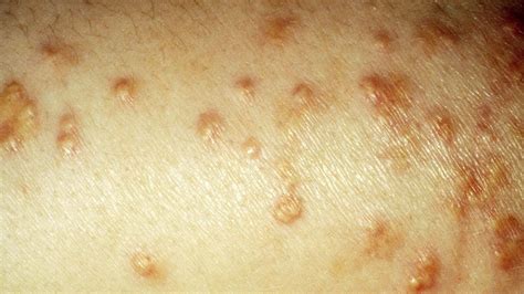 Skin Disease Due To Diabetes - DiabetesWalls