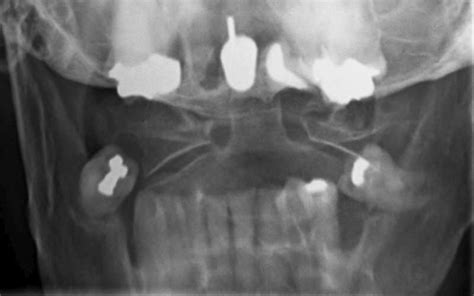 Odontoid Fracture X Ray