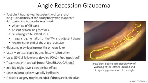 Lecture: Angle Recession Glaucoma (1 Slide in 5 Minutes) - YouTube