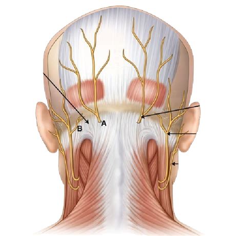 Occipital Nerve Block - NASHVILLE NEUROSCIENCE GROUP