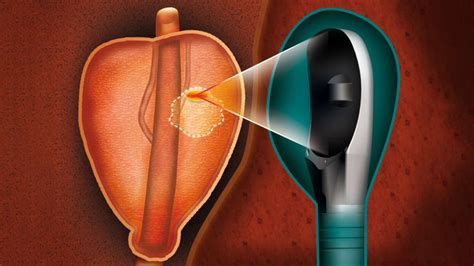 150 Milestone: Robotic Procedure Changes Prostate Cancer Care | UCSF ...