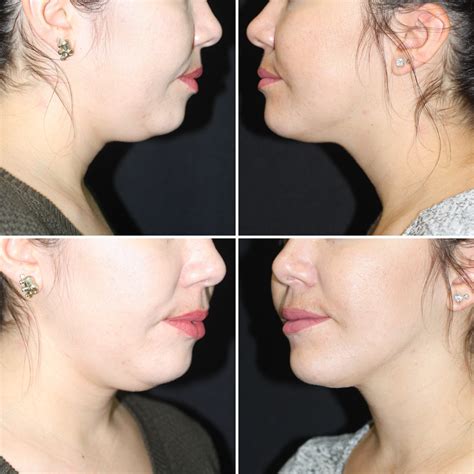 Double Chin Surgery in San Francisco Bay Area CA | San Francisco ...