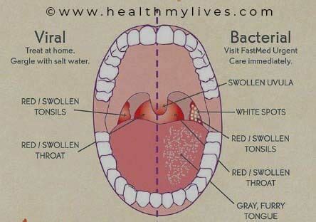 PHARYNGITIS-CAUSES, SYMPTOMS AND PREVENTION