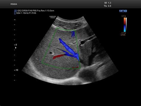 Ultrasound images • Liver, Color Doppler, echogramm №848