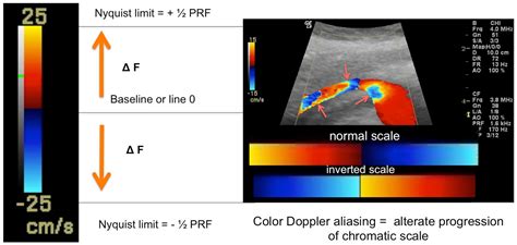 What Do The Colors Mean On Doppler Ultrasound Scan - Infoupdate.org