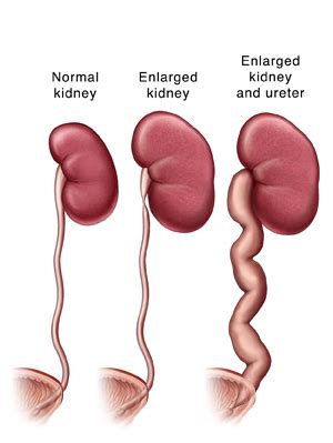 MNEMONICS: CAUSES OF ENLARGED KIDNEY