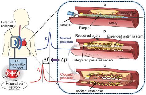 Enabling Angioplasty‐Ready “Smart” Stents to Detect In‐Stent Restenosis ...