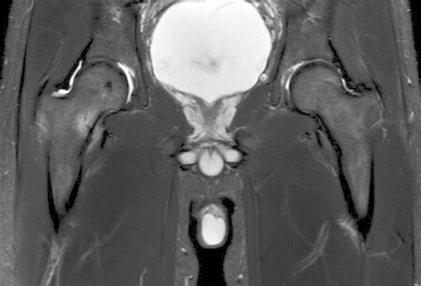 femoral neck Archives - OrthoBuzz