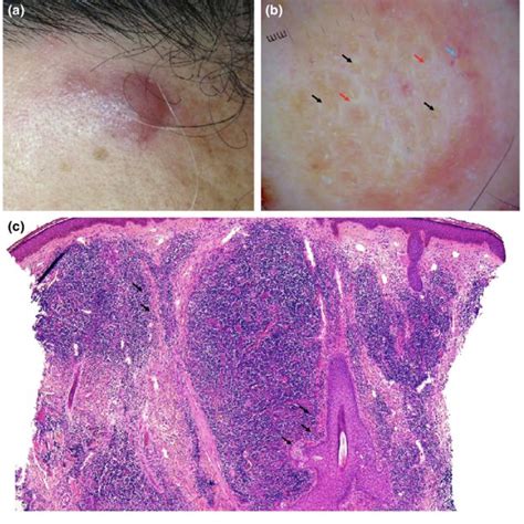 (a) Clinical picture of a primary cutaneous follicle center lymphoma ...