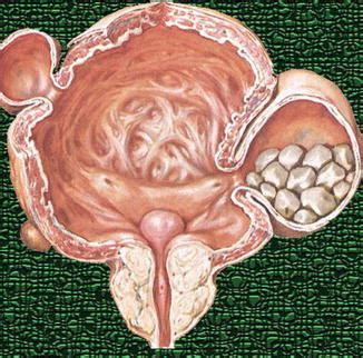 Diagnostic Imaging of Urinary Bladder Diverticula | Radiology Key