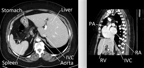 CT scan image of the great vessels showing that the main pulmonary ...