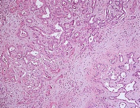 Cholangiocarcinoma Histology