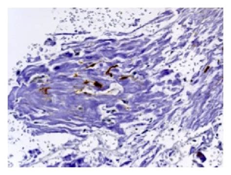 (a) Immunohistochemical findings showing strong positive staining for ...