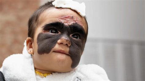 La tache noire sur le visage de la petite Luna commence à disparaître ...