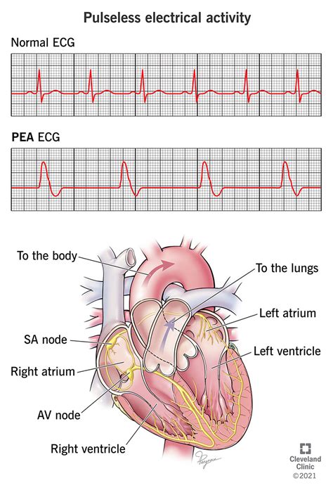 Pulseless Electrical Activity (PEA): Causes and Treatment