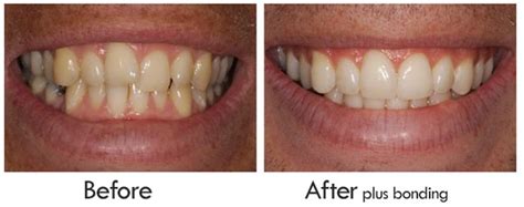 Magic of a Retainer: Before and After Photos to Prove It | New Health ...