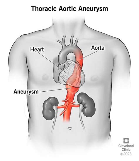 Thoracic Aortic Aneurysm: Symptoms & Treatment