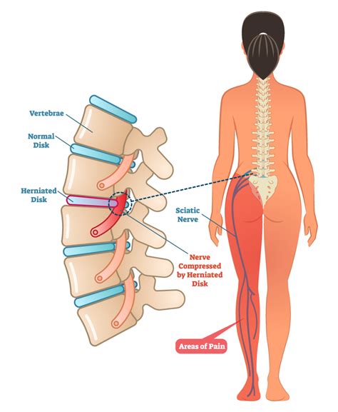 Sciatica | Altair Health