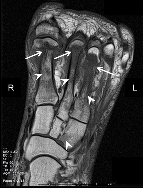 Acute Charcot foot | The BMJ