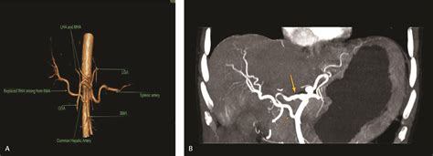 Assessment of Celiac Axis and Hepatic Artery Variations in ...